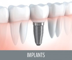 Dental Implants