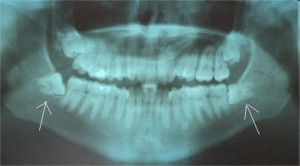 Wisdom teeth removal X-Ray
